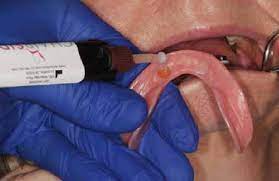 Oak wood and metal.kitchen chairside attachment processing. The Denture Air Dried And Chairside Attachment Processing Material Download Scientific Diagram