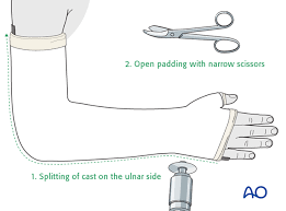 Image result for Long Arm Splint