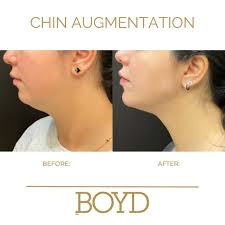 NON-SURGICAL Chin Augmentation by the 🐐 @drcharlesboyd To improve the  overall appearance of your face, creating a defined chin is key. Your chin  can add definition, and help create symmetry and balance