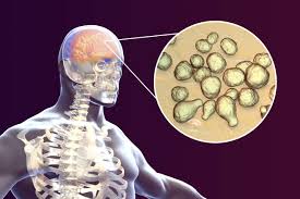 Image result for Cryptococcal Meningitis