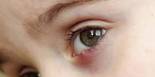 Que Son Los Orzuelos Y Los Chalaziones American Academy Of Ophthalmology