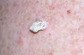 Image result for cornu cutaneum)