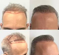 Celebrity hair loss, a blog written by renowned hair transplant surgeon, dr. Leonard Hair Transplant Associates Postimet Facebook