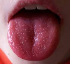 Strawberry Tongue A Feature Of Scarlet Fever Bumps On Tongue Tongue Sores Kids Dental Health