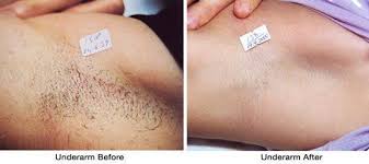 How much does electrolysis cost? Stop Shaving Plucking Waxing And Threading Ipl Professional Laser Hair Removal Is The Fastest Safest And Most Dark Armpits Hair Removal Hair Removal Cream