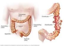 What are the warning signs of diverticulitis?