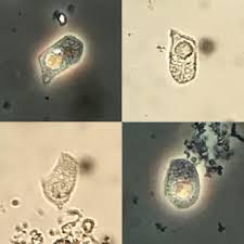 Tubular Epithelial Cells In A Patient With Aki2 Phase Contrast Bright Field X400 Urinarysediment Urine Nephrology Nephpearls Renal Cell Renal Urinal