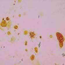 Bilirubin Crystal Entamoeba Histolytica Crystals Map