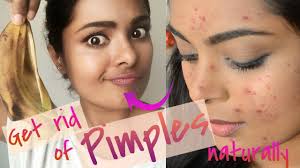 Usually 2 to 3 treatments are needed for a long lasting result. How To Get Rid Of Pimples Overnight Really Works Treat Acne At Home Naturally Cheap Diy Skincare Youtube