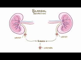 Image result for Postrenal Failure