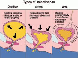 Suburethral Sling Urinary Incontinence Incontinence Nursing Mnemonics