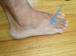 Causes of foot pain and treatment options. Running Injury Top Of The Foot And Ankle Pain Freeradical Me