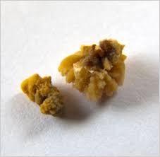 Inability to urinate or only passing small. Kidney Stones The British Association Of Urological Surgeons Limited