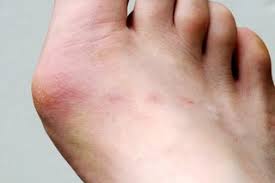 He knew exactly what my problem was, because his feet have the same problem. Bunions Nhs