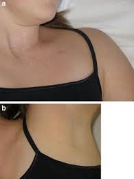The underlying condition is heart muscle disease, either because of coronary heart disease causing scarring after a heart attack or having not enough. Toward Improved Cosmetic Results A Novel Technique For The Placement Of A Pacemaker Or Internal Cardioverter Defibrillator Generators In The Axilla Of Young Patients Springerlink