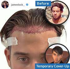 A bad hairline is typically caused by male pattern hair loss, genetics, poor diet, vitamin deficiencies, or other disorders. Hairstyle To Hide A Receding Hairline Used Post Transplant