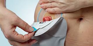 The first few times you change your colostomy bag on your own it will almost certainly feel challenging. Changing Your Ileostomy Pouch Open Drainable Pouch