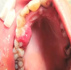 Image result for granuloma gum disease