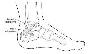 Tarsal Tunnel Syndrome Is Similar To Carpal Tunnel Syndrome Which Occurs In The Wrist Learn More Tarsal Tunnel Syndrome Carpal Tunnel Carpal Tunnel Syndrome