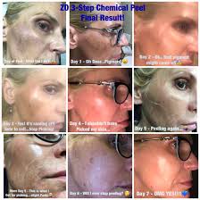 Zo Skin Health 3 Step Chemical Peel Chemical Peel Skin Health Skin