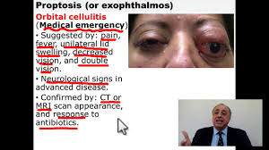 Image result for Proptosis