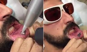 Even celebs are in on the trend: Man Has A Tattoo In The Inside Of His Lip Removed With A Laser Gun Daily Mail Online