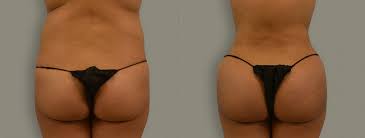 If you used to sleep on your back prior to your bbl surgery, behold! Athenix Body Sculpting Institute