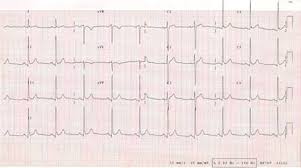 In such cases, ecg and echocardiogram are both normal. Causes And Management Of Myocarditis Rcemlearning
