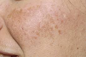 Image result for melasma