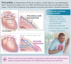 Image result for Pericarditis