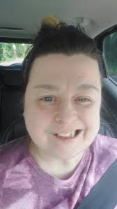 How bells palsy happen because of the anesthesia,