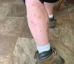 Image result for bedbugs bites