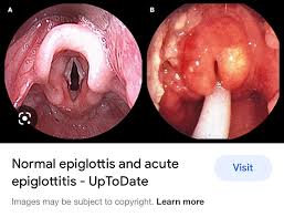 Image result for Epiglottitis