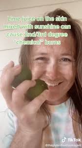 Beware of painful 'margarita burns' this summer party season