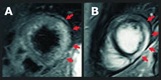 Se observan síntomas y signos de insuficiencia cardiaca, dilatación y disfunción ventricular. Miocarditis Aguda Diagnosticada Con Cardiorresonancia Magnetica A Se Download Scientific Diagram