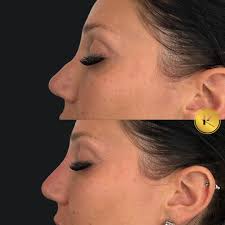 Angela Kane, RN, Advanced Nurse Injector, Educator