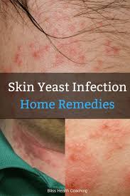 Pin On Yeast Infection