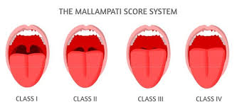 A high mallampati score (class 4) is associated with more difficult intubation as well as a higher incidence of sleep apnea. What Is The Mallampati Score Myofunctional Therapy Exercises For Mouth Breathing Sleep Apnea Braces And Speech