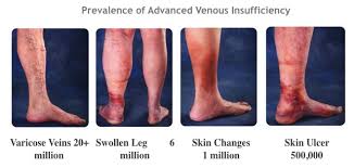 Signs And Symptoms Of Varicose Veins