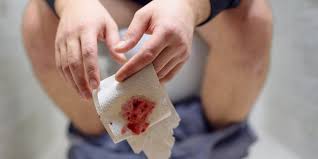 Image result for blood in stool human poop