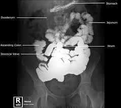 Abdominal Radiographic Anatomy Wikiradiography Radiology Imaging Medical Radiography Radiology Schools