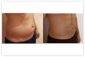 Je ne me pose plus aucune question, car. Liposuccion Des Hanches De La Taille Poignees D Amour Dr Picovski Paris