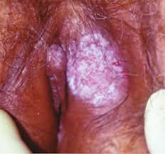 Enfermedad de Paget extramamaria. Reporte de un caso