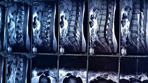 Image result for Low Back Imaging