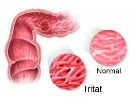 Intestin Iritabil Atenție Alimente Interzise Doza De Sănătate Digestive Health Colon Food