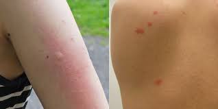 Thus, it is important to act on removing these small itchy bumps before it converts to. Bed Bug Bites Vs Mosquito Bites What S The Difference Insider