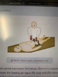 Image result for Pelvic Compression Test