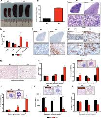 Mesothelioma, lung cancer, bap1, differential diagnosis, immunohistochemistry. Loss Of The Tumor Suppressor Bap1 Causes Myeloid Transformation Science