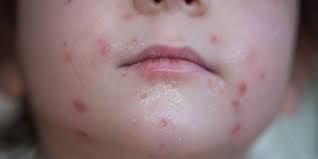 Virus hiv ini akan menginfeksi dan menghancurkan sel cd4 dalam tubuh. Artikel 3 Penyakit Yang Disebabkan Oleh Virus Ini Bisa Menyerang Kulit Anda