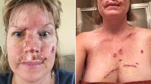 Basal cell carcinoma is usually caused by sun exposure, with bumps and lesions appearing on. Woman Shares Graphic Skin Cancer Selfies To Warn Of Dangers Of Sunbeds Itv News